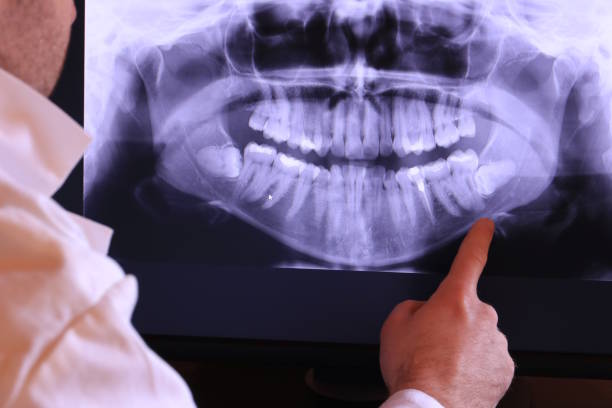 Best Emergency Wisdom Teeth Removal in Randolph, NE